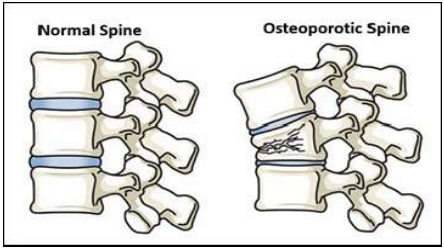 Osteoporosis - Porous Bones - PhysioCare Centre - Physiotherapy - Mahim | Mumbai